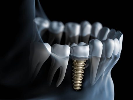 dental implants OC